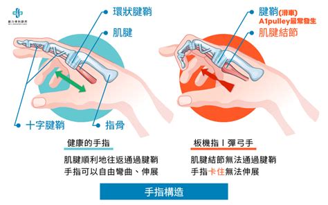 小指第一節彎曲|手指彎曲就伸不直？板機指介紹：疾病成因、症狀、簡。